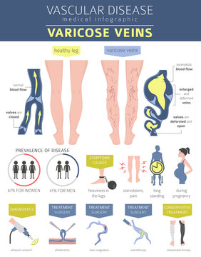 Vascular diseases. Varicose veins symptoms, treatment icon set. Medical infographic design