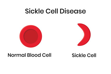 Sickle cell anemia. Normal erythrocyte against distorted sickle cell.