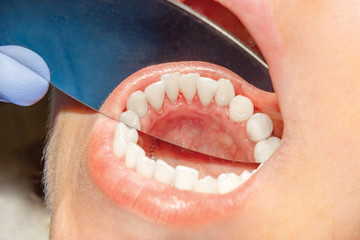 Plaque of the patient, stone. Dentistry treatment of dental plaque, professional oral hygiene. The...