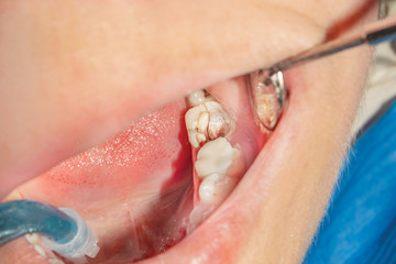 close-up of a fracture of a human molar tooth fracture. The concept of dental prosthetics and...