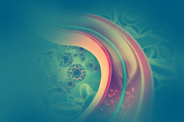 Stent angioplasty. 3d illustration