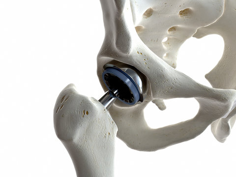 3d rendered medically accurate illustration of a hip replacement