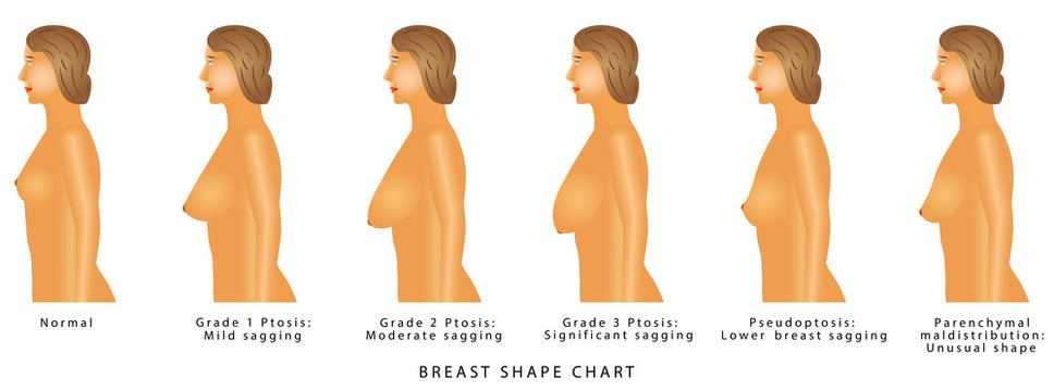 Breast Shape chart