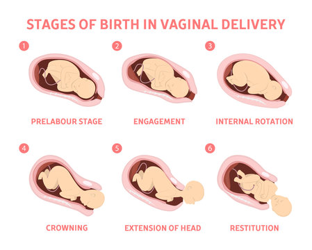 Stages of baby birth in vaginal delivery