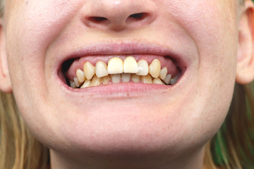 Close-up of unsuccessfully implanted dental implants