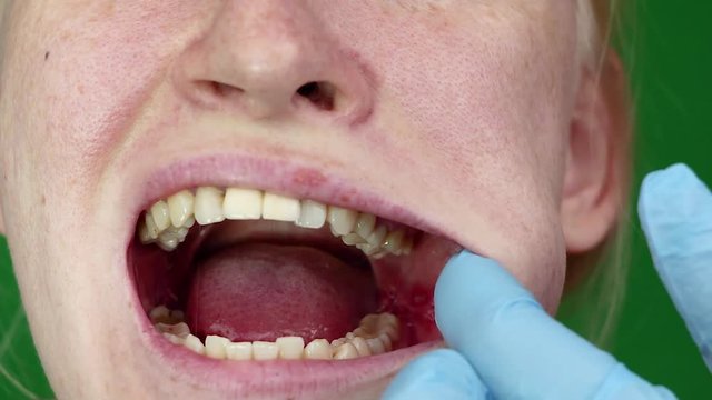 A woman with stomatitis on her cheek. Consequences after the removal of wisdom teeth. Macro cheek and wound on her. Seams on the gums are seen close-up. 