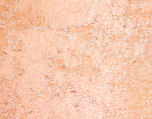 burned skin macro