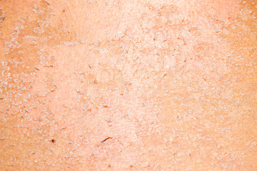 burned skin macro