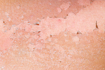 burned skin macro