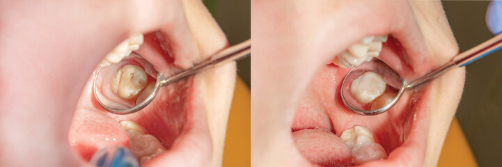 Treatment of caries of a human tooth close-up. The concept of dental restoration of the tooth with...