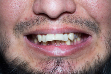 male lips with untrimmed beard at closeup.Close up of male part of face. angry,grumpy,loony man.