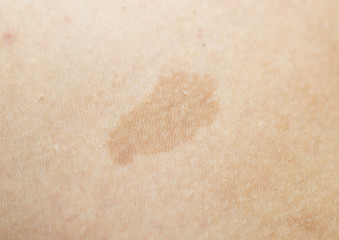 stain on human skin