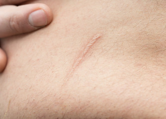 Fototapeta premium appendicitis scar on the man's stomach