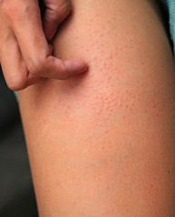 Hand scratching allergic rash dermatitis eczema on skin.