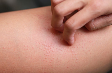 Allergic rash dermatitis eczema on skin. Hand scratching.