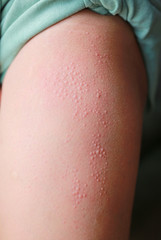 Close-up Allergic rash dermatitis eczema on skin.