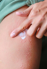 Hand applying ointment to dermatitis skin allergic rash. Skin care concept.