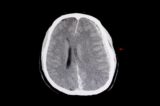 CT brain intracerebral hemorrhage and brain edema