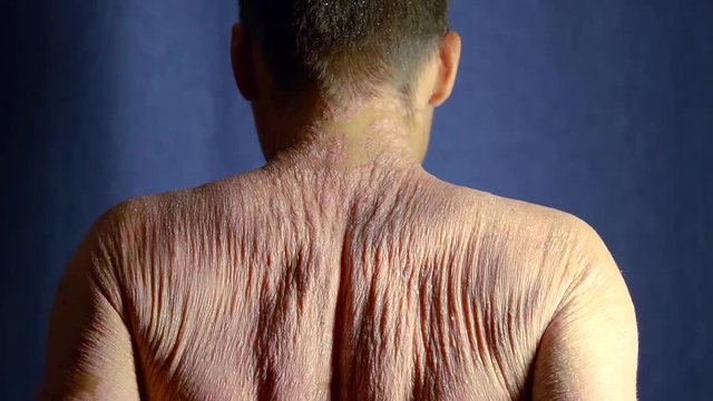 male patient is demonstrating his skin of back covered psoriasis in dark room, moving shoulders