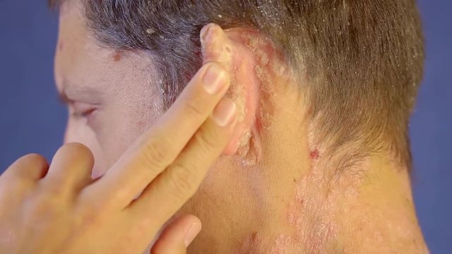 man with psoriasis is demonstrating patches of abnormal skin behind an ear, close-up