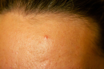 Fototapeta premium post-acne, scars and red festering pimples on the face of a young woman. concept of skin problems and harmonic failure