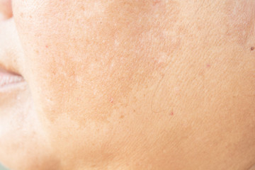 Fototapeta premium freckles on the face. in old women