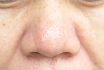 Pores on the nose and skin problems are not smooth.