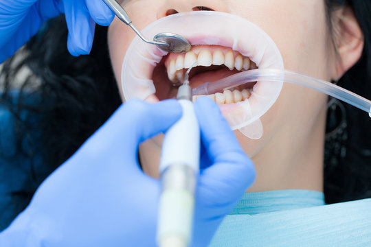 A woman in the dental hygienic and dental clinic professional teeth whitening and ultrasonic cleaning. Odontics and health of the mouth.