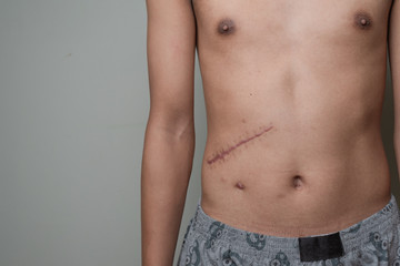 Fototapeta na wymiar Scar cicatrix pain on human skin