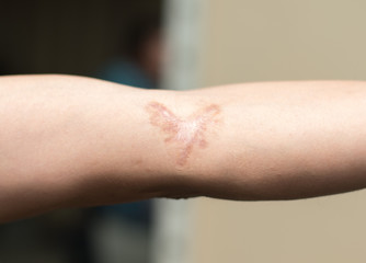 A scar in one's hand