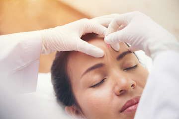 Relaxed Young asian Woman Receiving Acupuncture Treatment In Beauty Spa