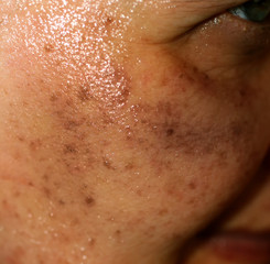 Naklejka premium Pigmented spots on the face. Pigmentation on cheeks
