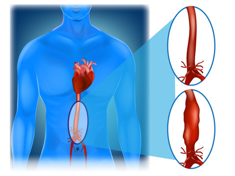 Abdominal aortic aneurysm - location and appearance. 