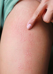 Close-up Allergic rash dermatitis eczema on skin.

