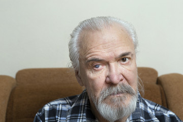 Eye disease in an old man