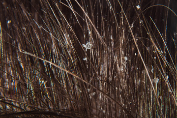 Dandruff on male dark hair