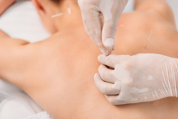 cropped shot of cosmetologist putting needles on womans back during acupuncture therapy in spa salon