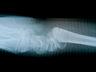 x-ray film skeleton human arm. health medical anatomy body concept