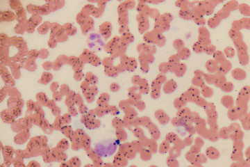 Study of white blood cells are the cells of the immune system under the microscope in laboratories.