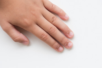Obraz na płótnie Canvas Close up child's fingers with dry skin, Eczema Dermatitis. Medicine and health care concept.