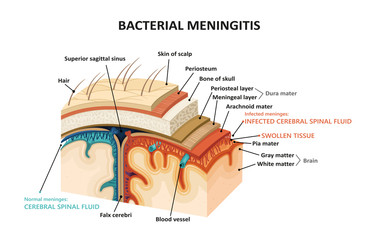 Bacterial meningitis - obrazy, fototapety, plakaty