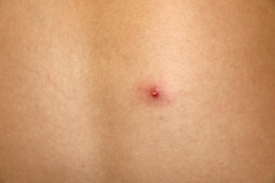 Close up of a pimple on the back