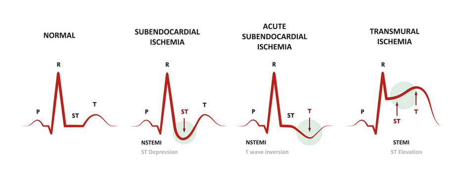 Diagnosis of Myocardial Ischemia (NSTEMI, STEMI) EKG of subendocardial ischemia and transmural ischemia