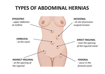 Types of abdominal hernias