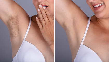 Before And After Concept Of Underarm Hair Removal