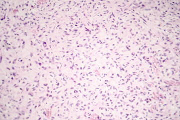 Light micrograph of malignant cells, photo of cancerous tumor under microscope