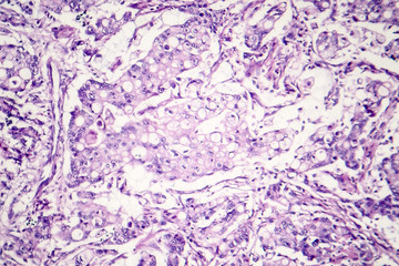Obraz premium Mucinous carcinoma of the stomach, light micrograph, photo under microscope