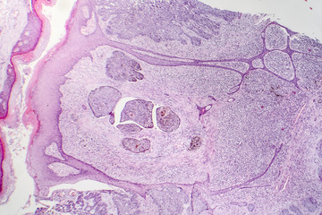 Basal cell carcinoma, skin cancer, light micrograph, photo under microscope