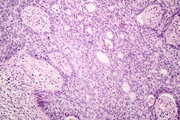 Basal cell carcinoma, skin cancer, light micrograph, photo under microscope