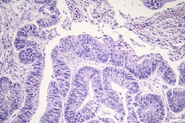 Esophageal squamous cell carcinoma, light micrograph, photo under microscope